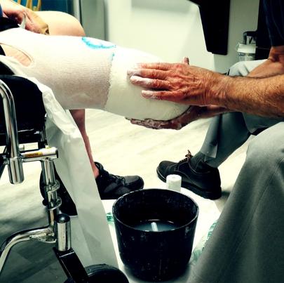 A male prosthetist wraps a plaster cast around the amputated limb