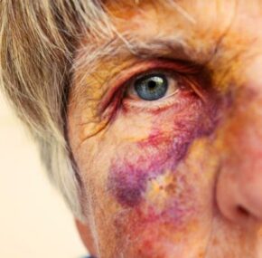 Physically abused senior woman in a nursing . Close up of black eye