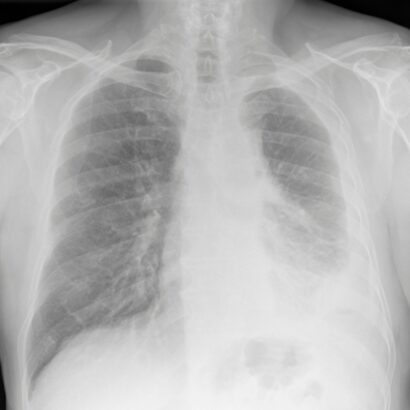 Digital chest x-ray of advanced malignant Mesothelioma