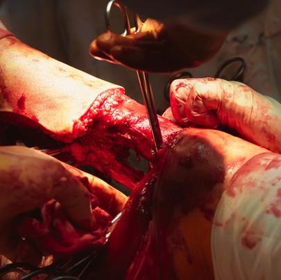 Surgeon shears all the tissues from the bone during a leg amputation surgery