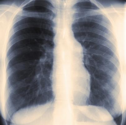 X-ray image of lungs with disease