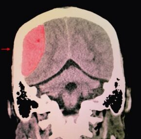 A brain CT scan of a patient with traumatic brain injury